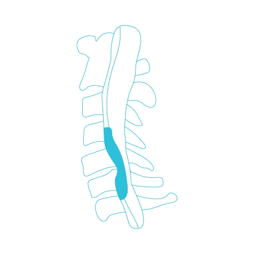 Spinal-Stenosis-Σπονδυλική-Στένωση
